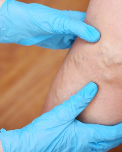 Venous Health